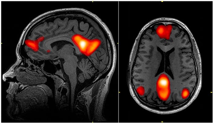 Default mode network: si può smettere di pensare? NO!